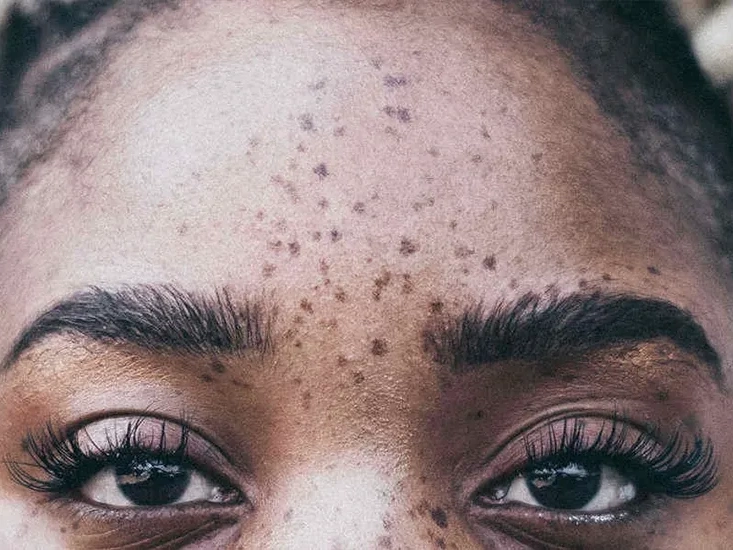 Laser Treatment Nairobi - Freckles