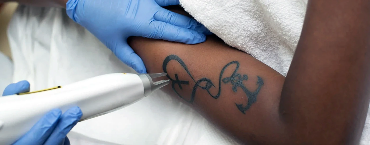 LASER TATTOO REMOVAL - Bare Element